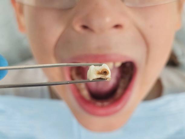 Best Emergency Dental Extractions in Bellerose, NY
